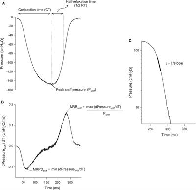 Multiparametric Analysis of Sniff Nasal Inspiratory Pressure Test in Middle Stage Amyotrophic Lateral Sclerosis